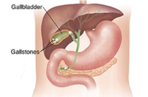 Gallbladder Laparoscopic | Dr. Digant Pathak